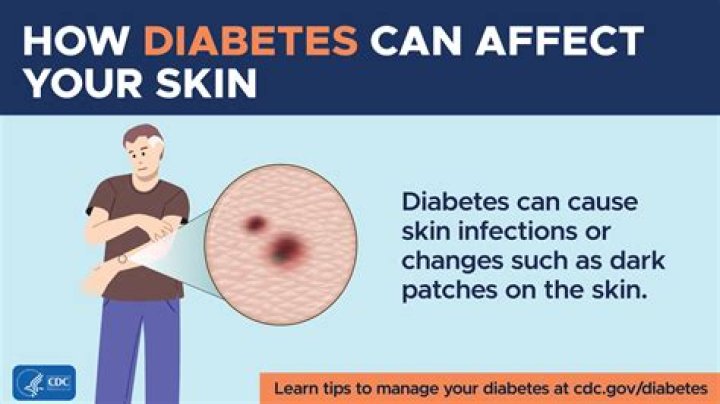 Can a Type 1 diabetic get a mortgage?