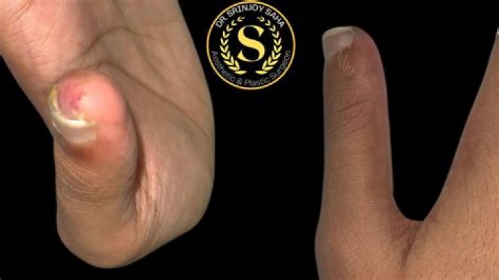 Can thumb skin grow back?