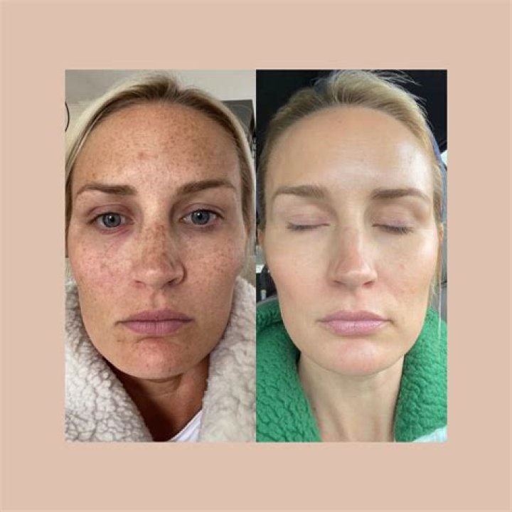 How do you fix skin pigmentation?