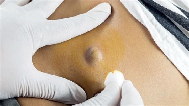 How do you get rid of a cyst sac at home?