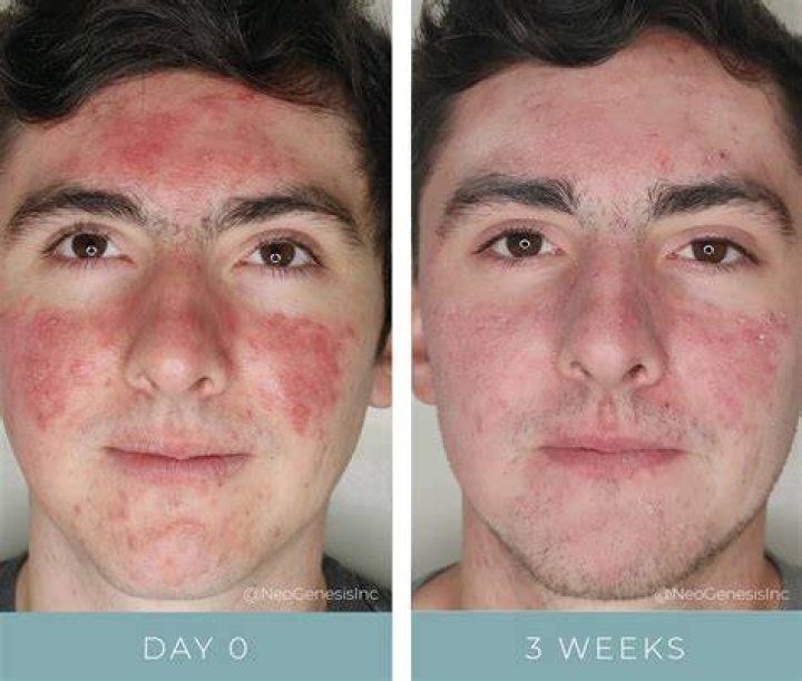 How do you get rid of acid burn on skin?