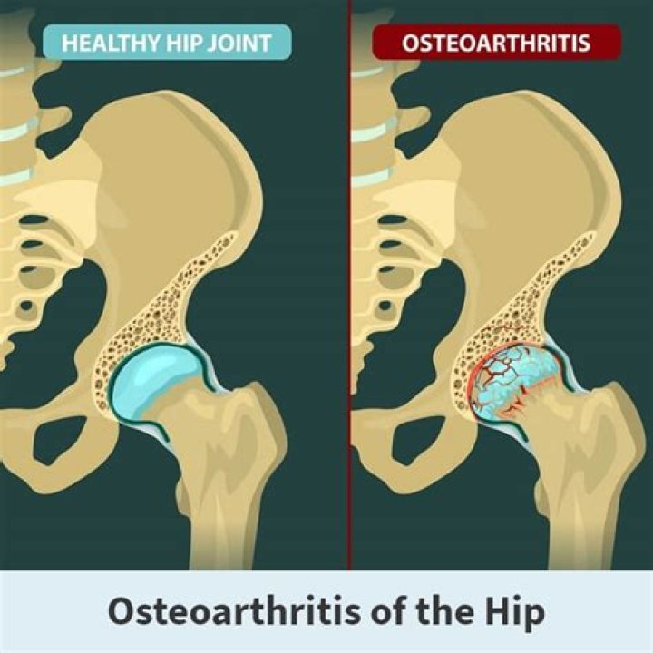How does a doctor clean out arthritis?