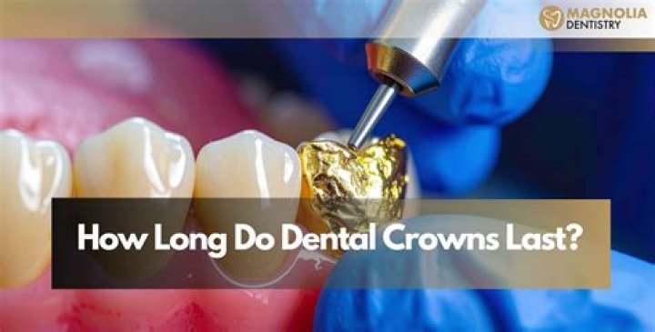 How long do dental gold crowns last?