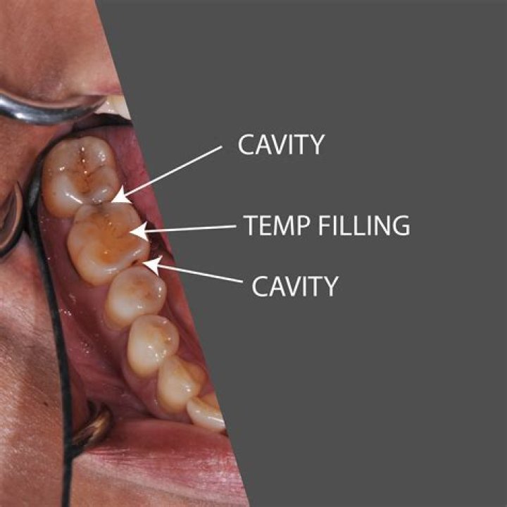 How much does a tooth filling cost in Atlanta?