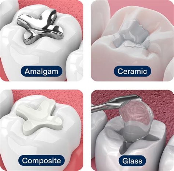 Is amalgam always silver?