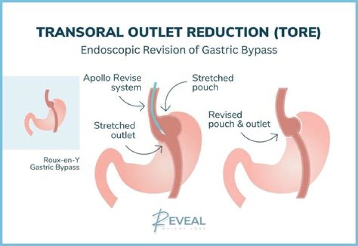 Is it hard to get approved for gastric bypass?