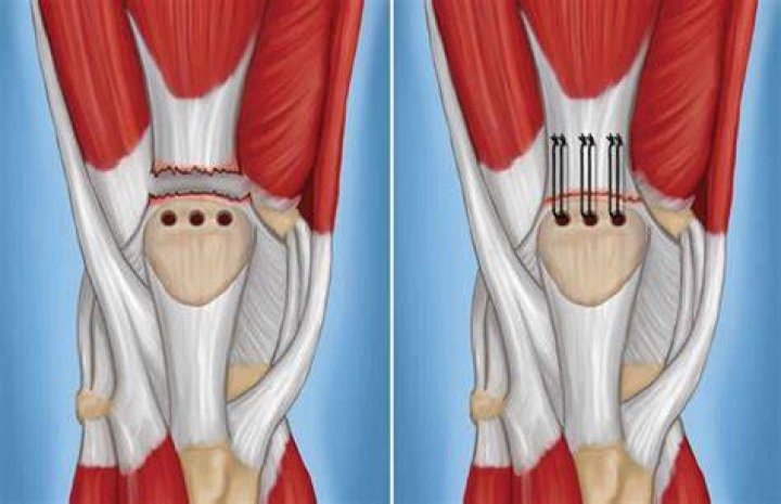 What does a partial quad tear feel like?