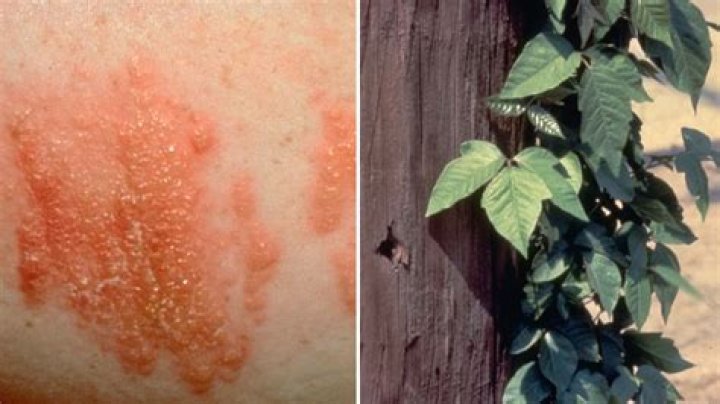 What does poison ivy rash look like when it first starts?