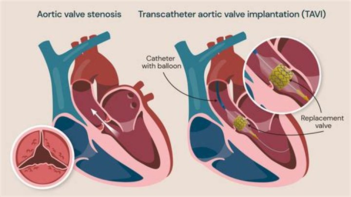 What is the average age for aortic valve replacement?