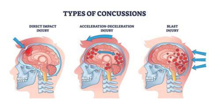 What percent of Americans have had a concussion?